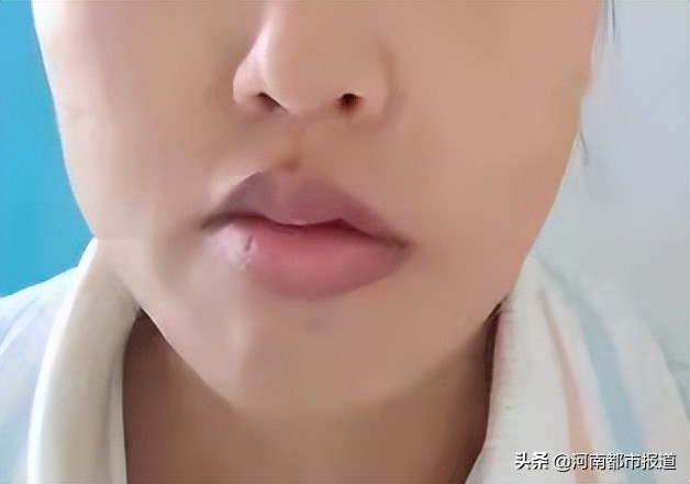 当孕期遇上荨麻疹,孕期面瘫