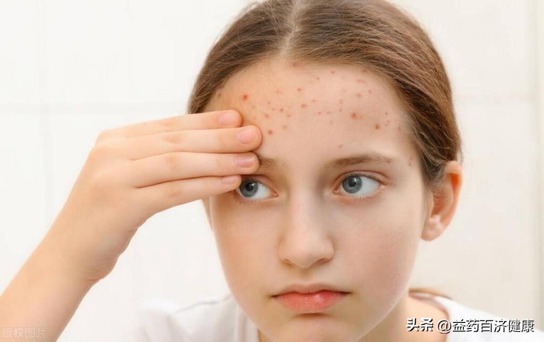 治痘痘口服异维a酸外配什么药膏,治疗痘痘吃异维a酸可以化妆吗