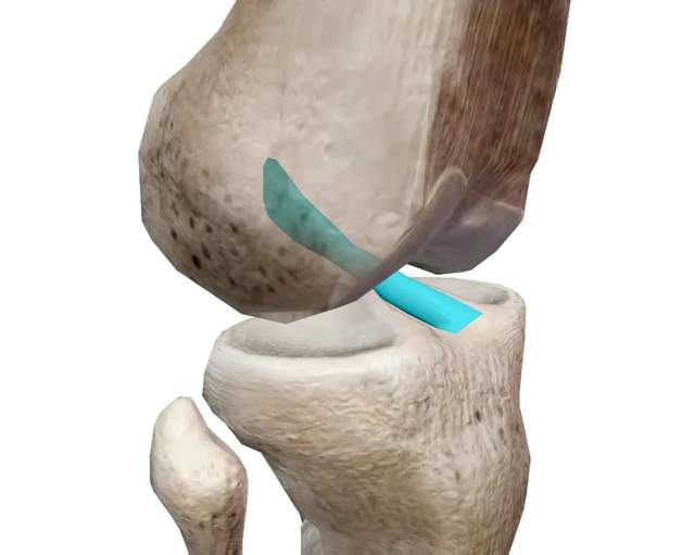 打篮球前十字交叉韧带断裂，到底该如何康复？