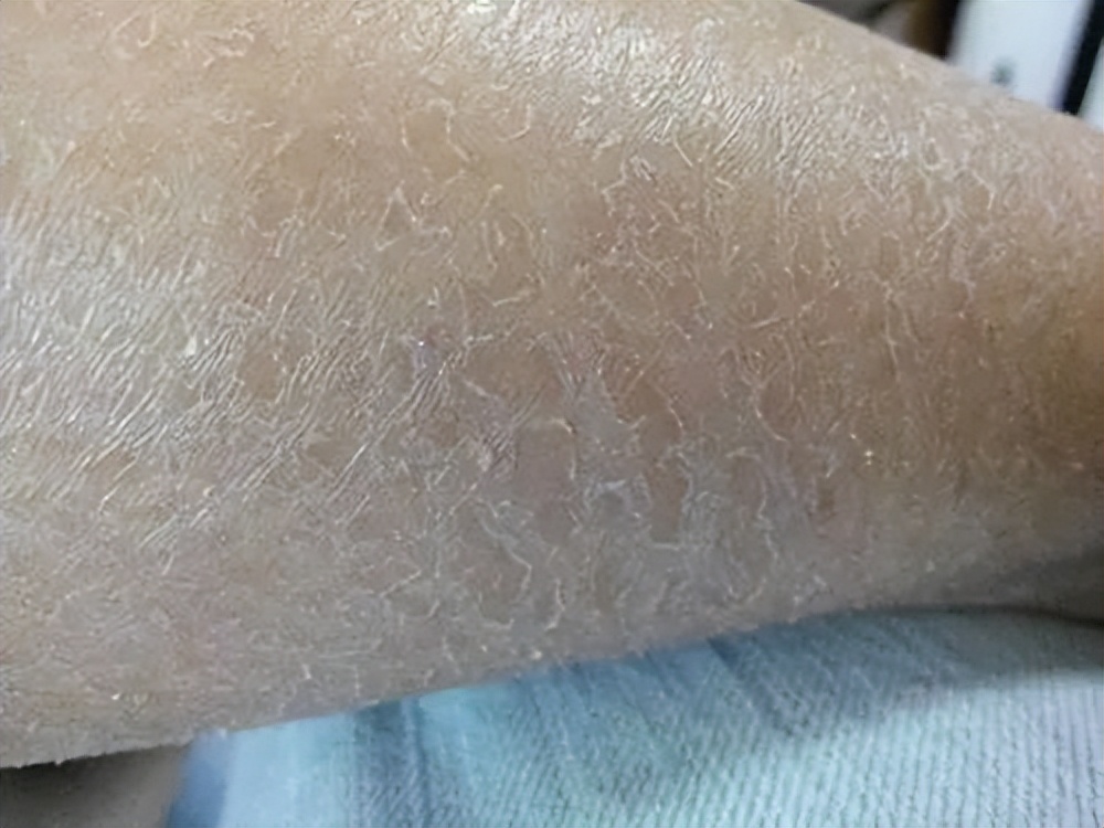 冬季皮肤干燥起皮有纹,皮肤干燥起蛇皮纹