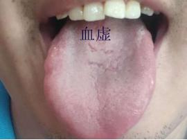 舌头上有裂纹是哪出现了问题,舌头上有裂纹加重是什么原因