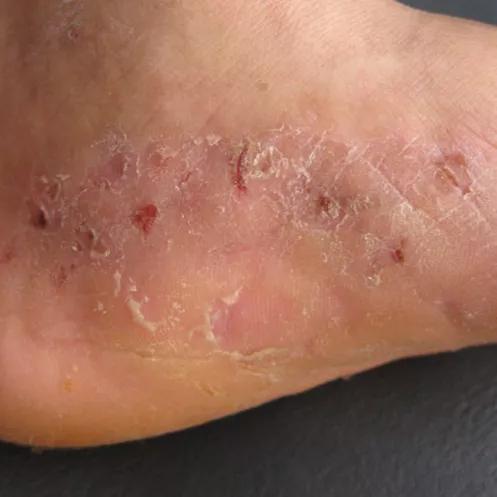 脚底突然出现大规模脱皮,脚底脱皮痒死了怎么办