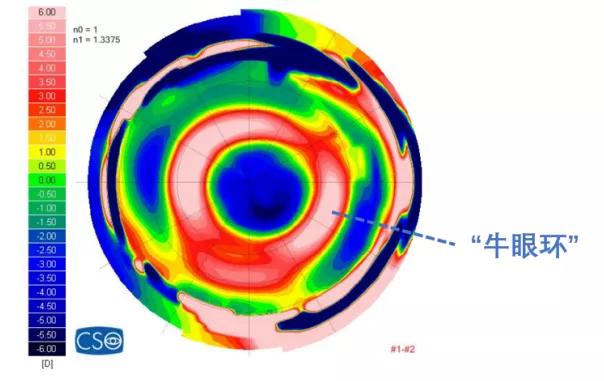 角膜塑形镜控制度数的原理是什么,角膜塑形镜控制近视度数增长