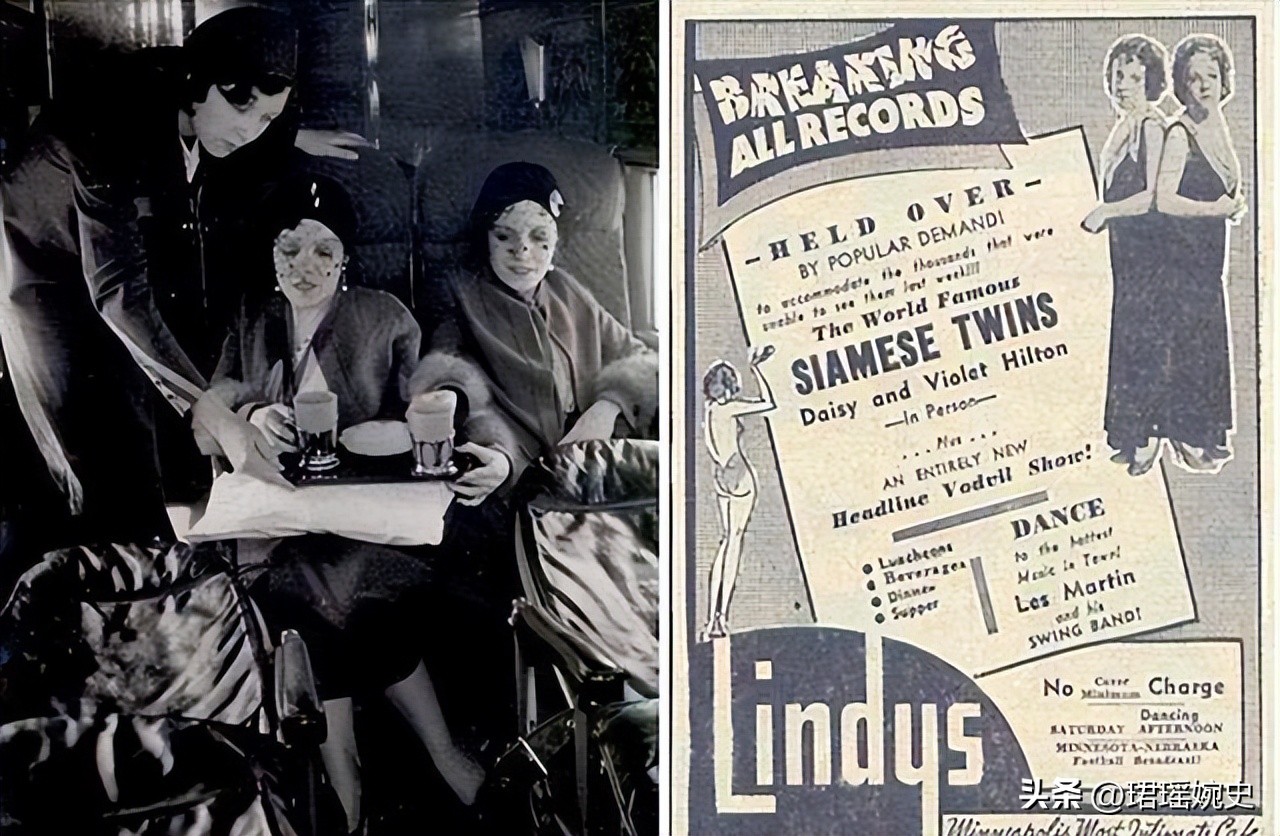 英国连体双胞胎姐妹,英国连体姐妹