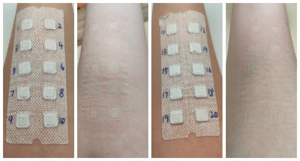 蚊子叮咬止痒消肿膏推荐,蚊虫叮咬止痒药膏测评推荐