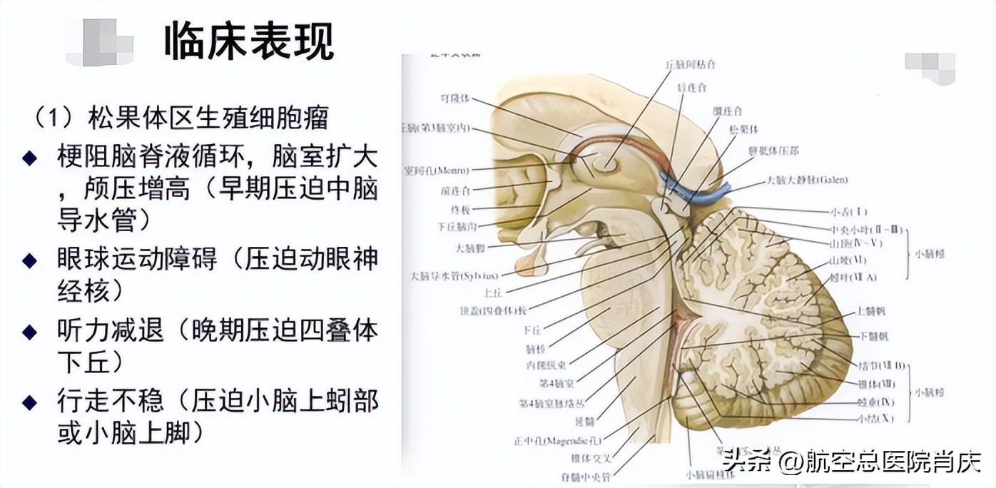 软性神经内镜帮助颅内肿瘤患者与病魔做斗争！