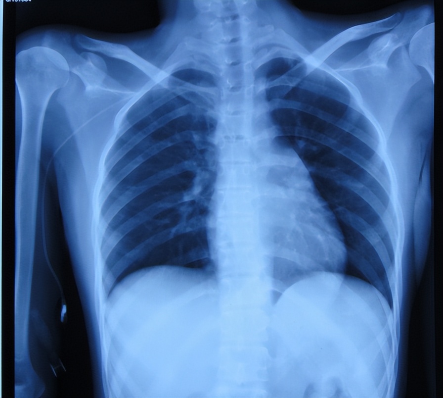 结核性脑积水能治愈吗,儿童结核脑膜炎脑积水