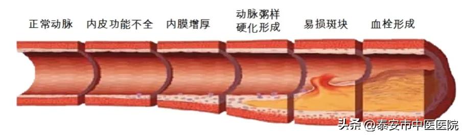 大连中医治疗下肢动脉硬化闭塞症,警惕动脉硬化的杀手