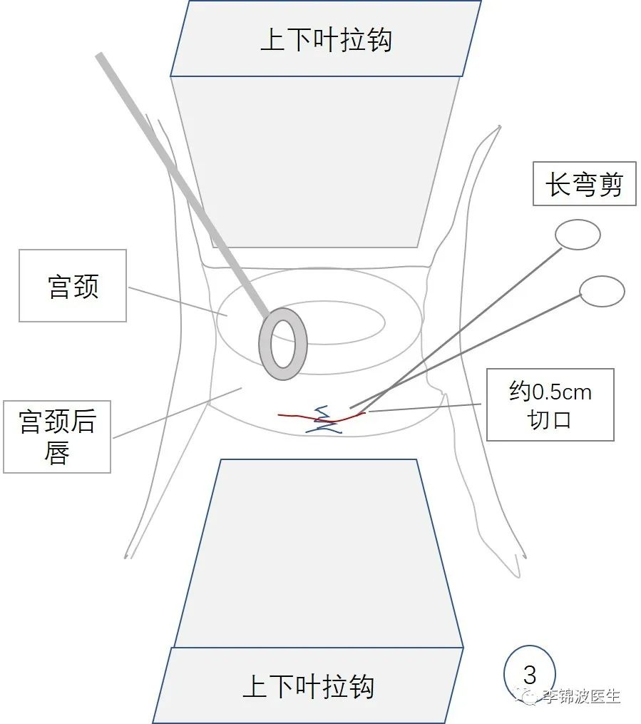 拆除高位宫颈环扎线的步骤和注意事项