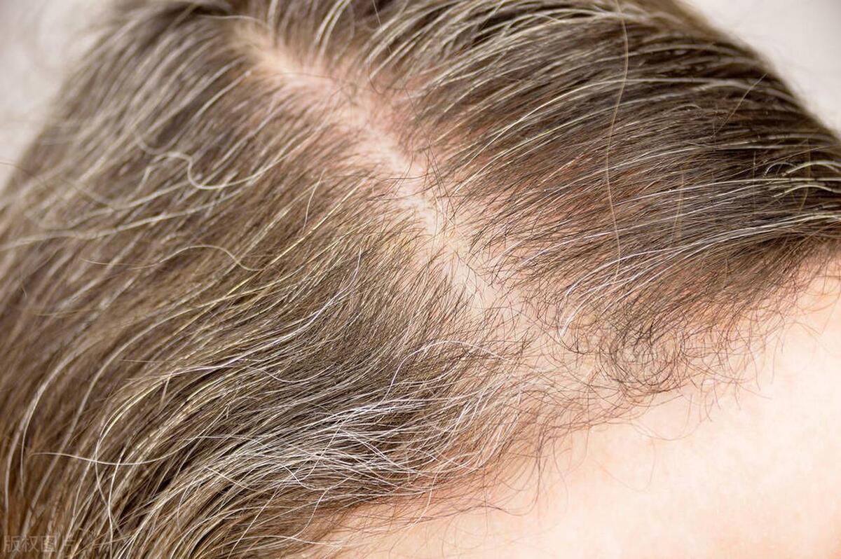 治疗白发脱发营养素,白发突然增多可能是缺少营养素