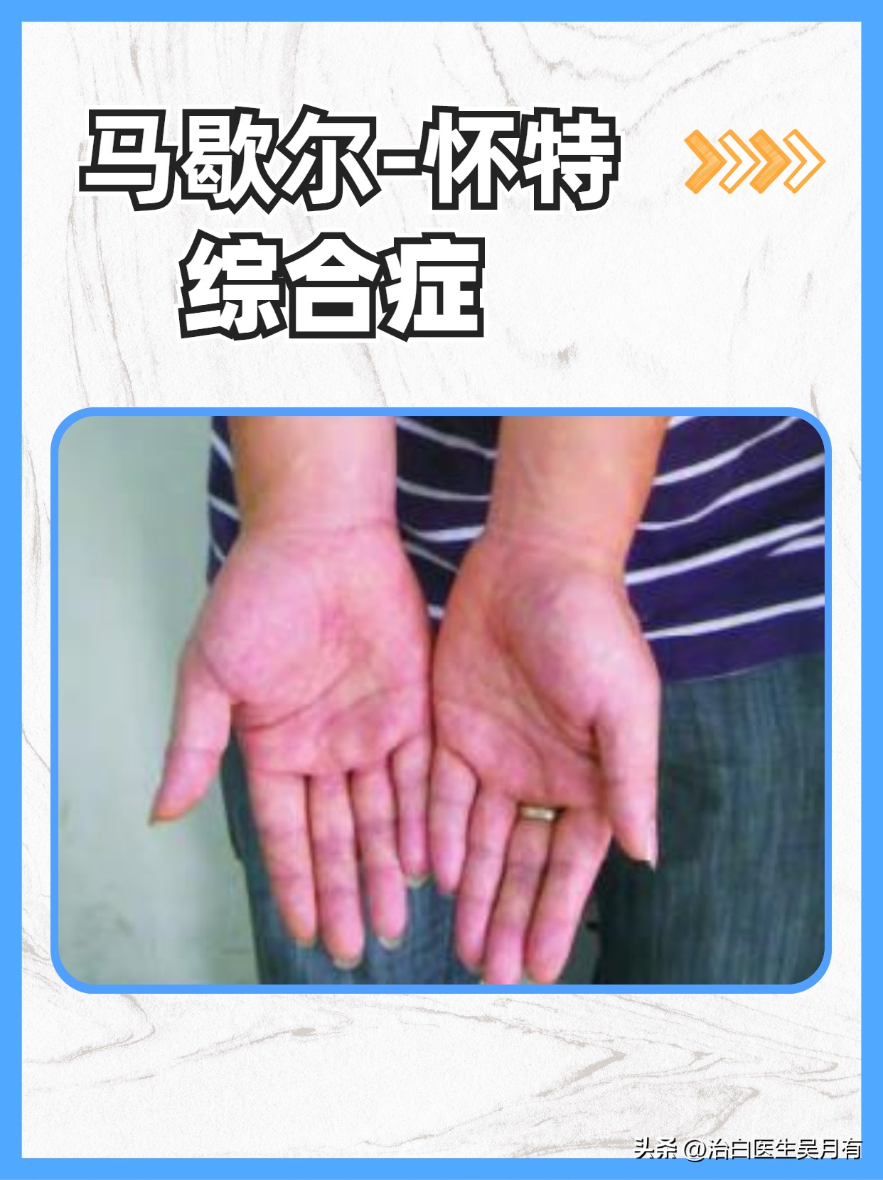 各种斑与白癜风的区别,所有的白斑都是白癜风