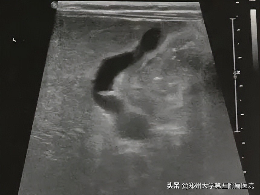 黄疸患者如何用超声诊断与鉴别,小儿黄疸超声筛查