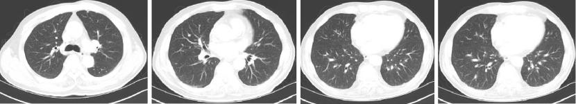 中国国内结直肠癌最新治疗,结直肠癌治好的可能性大吗
