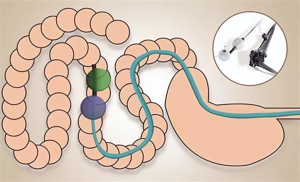 现在做肠镜和前几年做肠镜一样吗,肠镜正常一般几年做一次肠镜