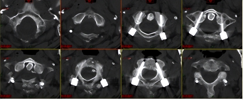 挑战骨折康复,颈椎如果摔断了会有什么后果