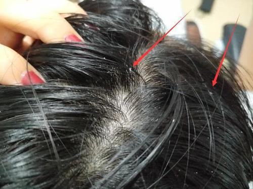 每天都有洗头，还是发痒有头屑甚至掉发？