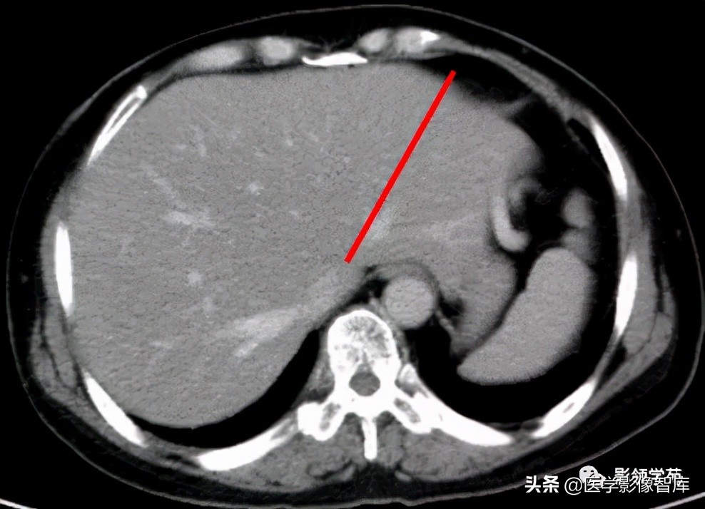 肝脏影像分叶分段解剖图,肝脏分段解剖图谱