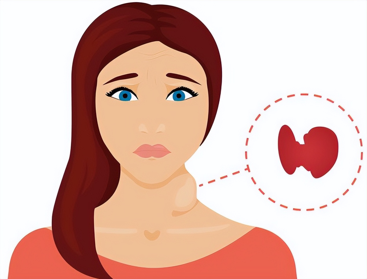 甲亢是怎么引起的呢,甲亢是怎么引起的呢视频