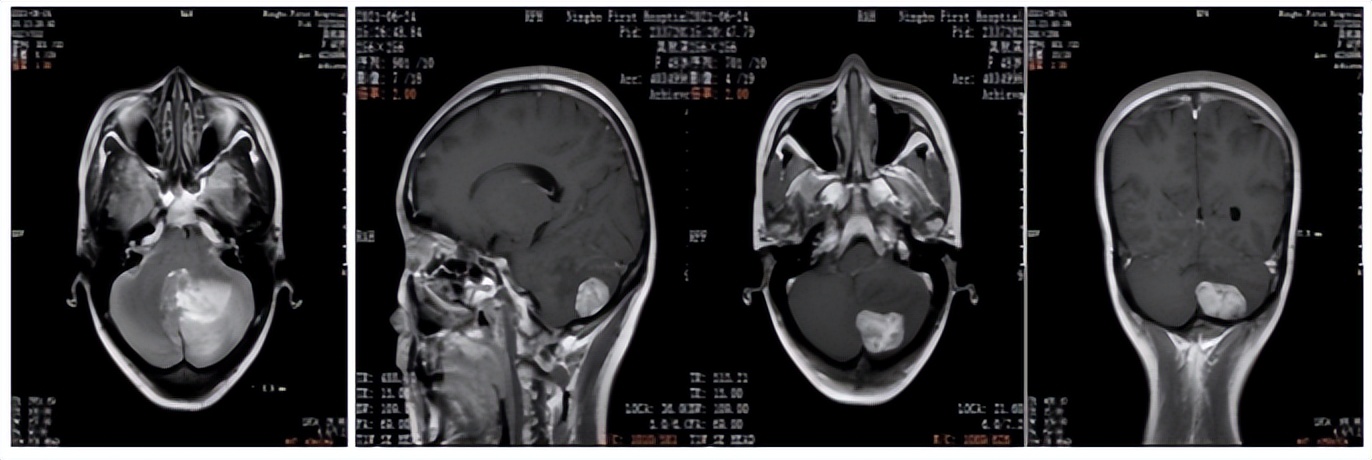 her2阴性乳腺癌脑转移生存期,乳腺癌her2脑转移概率