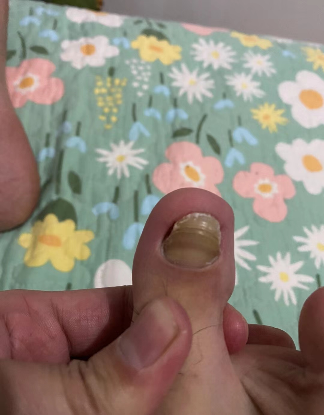 一招搞定灰指甲,祛除灰指甲只需5秒