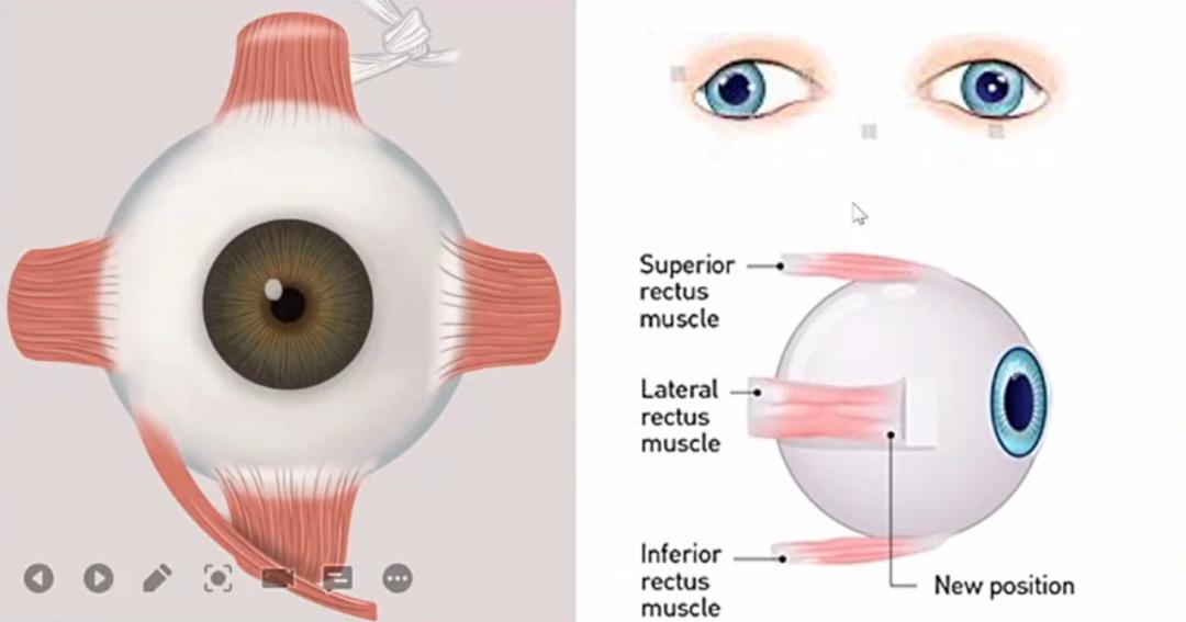 中山眼科陈静嫦做斜视手术吗,中山眼科陈静嫦做斜视手术好吗