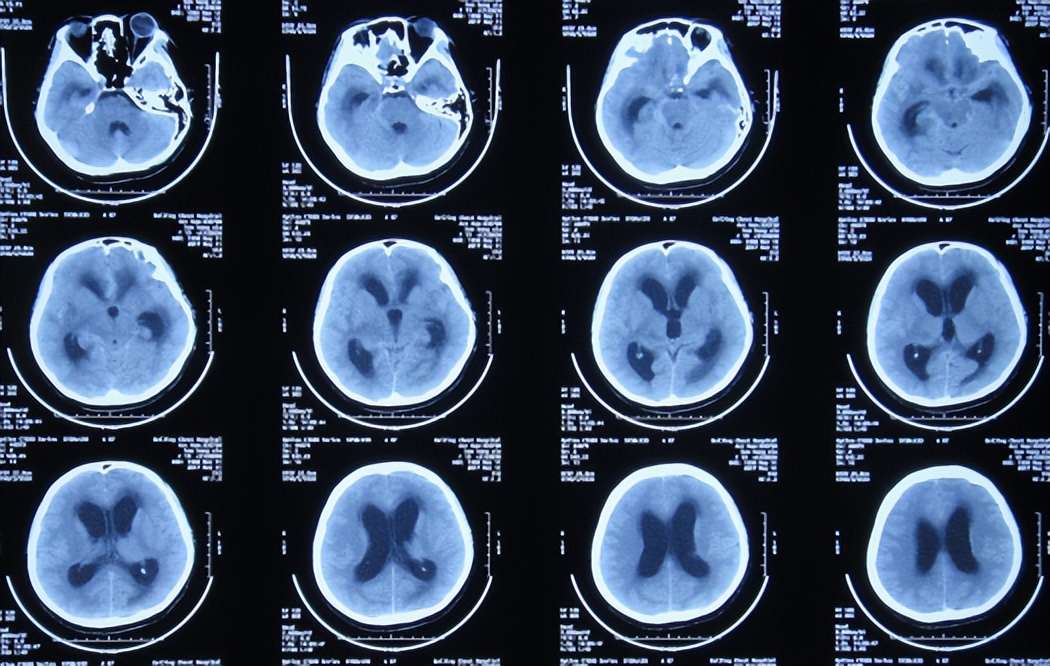 结核脑炎型脑积水怎么治,结核性脑膜炎2期很严重吗