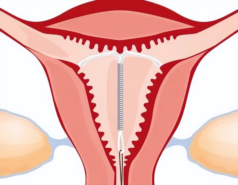 产后不避孕百发百中?选对避孕时机是关键