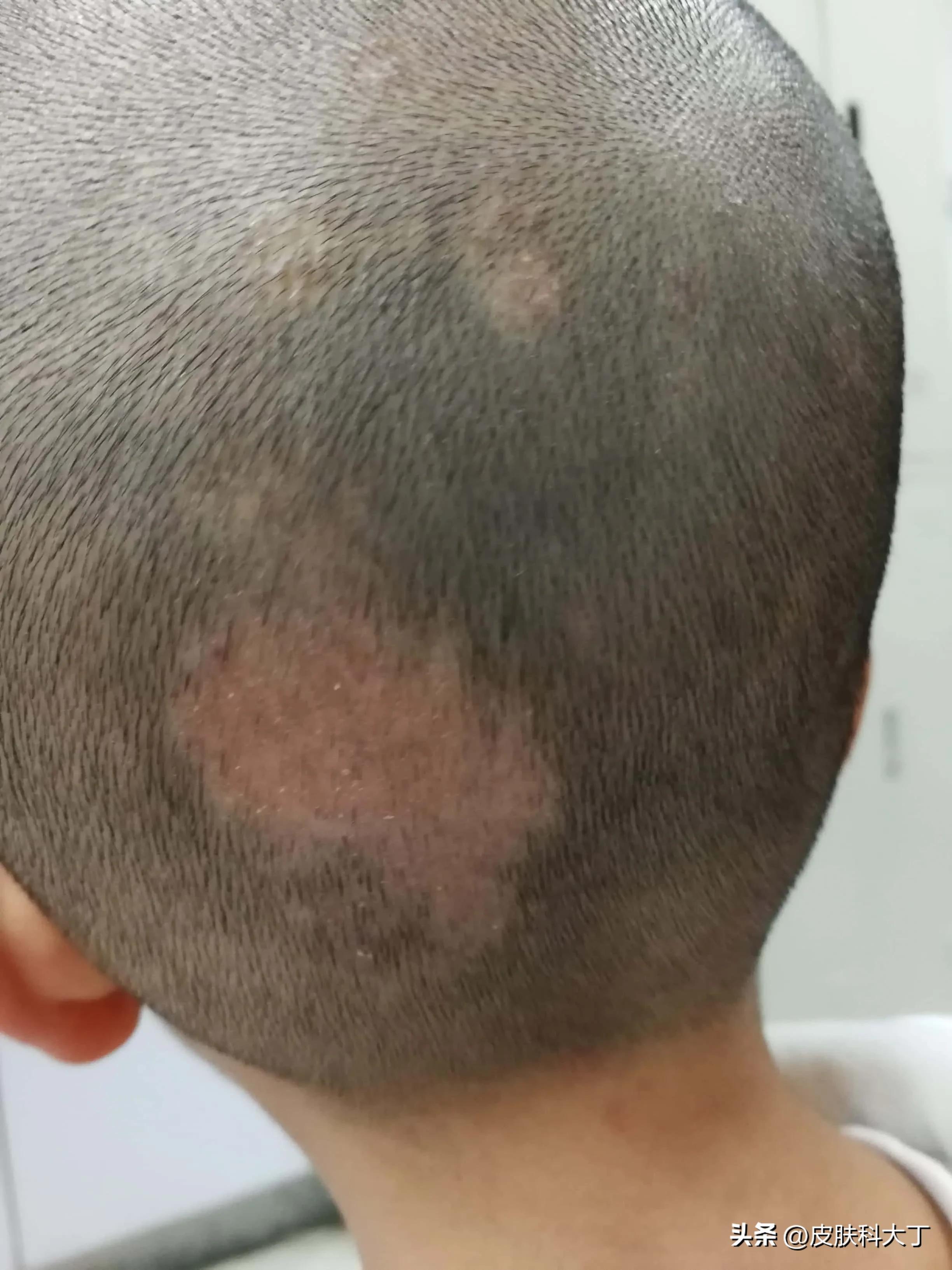 宠物狗容易导致小孩患头癣,因养狗得了癣怎么治