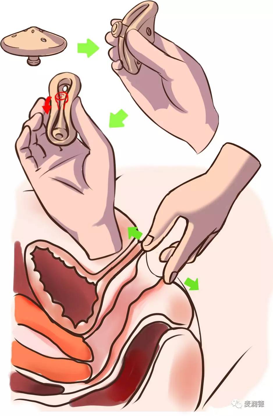 【健康小科普】中医针灸治疗中老年女性压力性尿*禁失**有何优势？