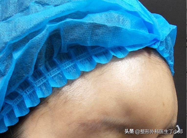 额头填充成寿星公怎么办,额头太尖而窄怎么填充