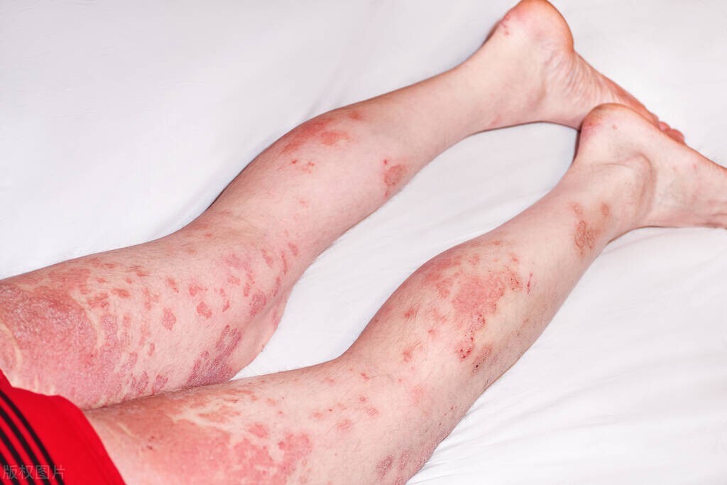 皮肤有这4种迹象当心艾滋病,早期艾滋会出现什么皮肤病