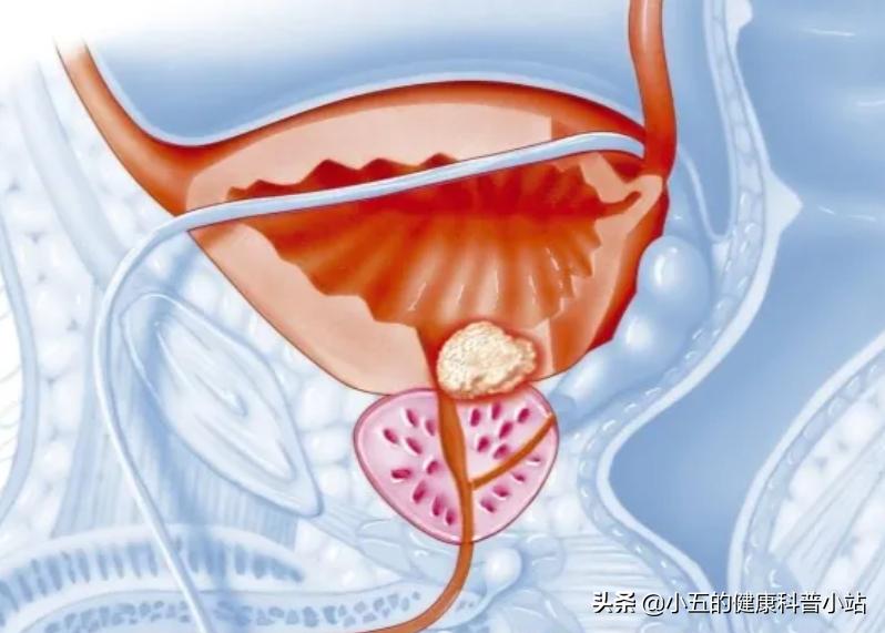 前列腺增生治疗期间注意什么,前列腺增生的日常护理与治疗