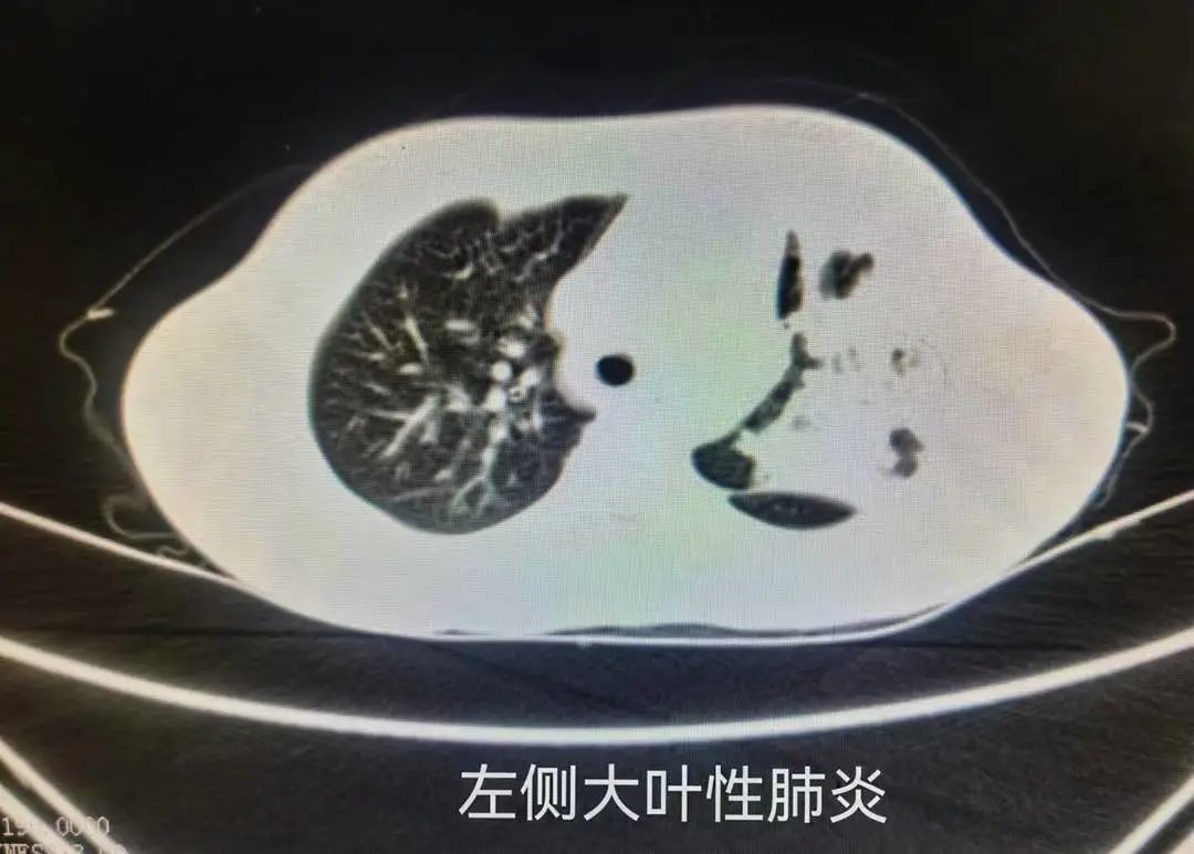 警惕儿童肺炎支原体高发,徐州儿童医院支原体肺炎