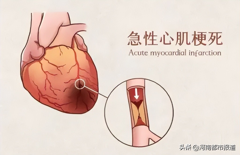 听说过心梗脑梗吗,心梗和脑梗的几大信号