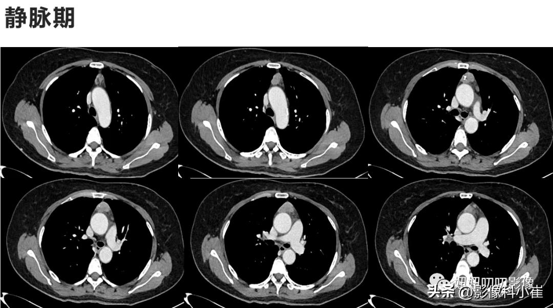 前纵隔到底是什么病,前纵隔疾病发生症状