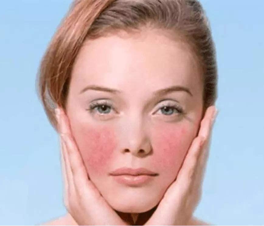 脸部皮肤又红又痒，是过敏了吗？正确的护理方法要牢记