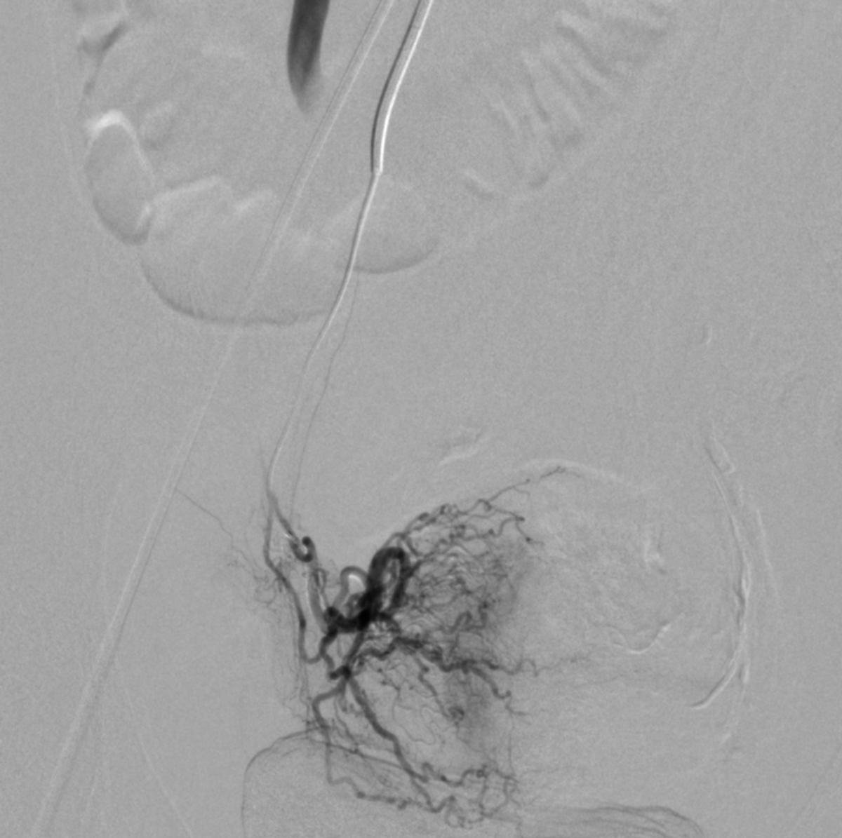 14岁女孩非经期出血,14岁女孩非月经期出血是怎么回事