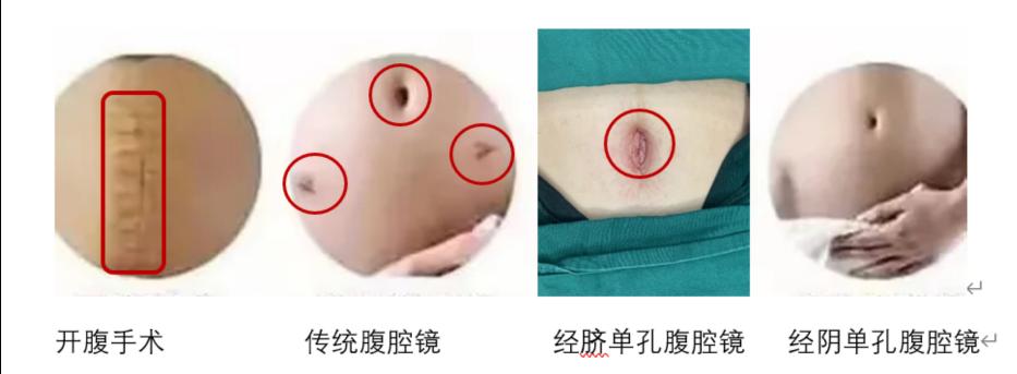 技术创新|妇产科完成首例经阴道单孔腹腔镜子宫内膜癌分期手术