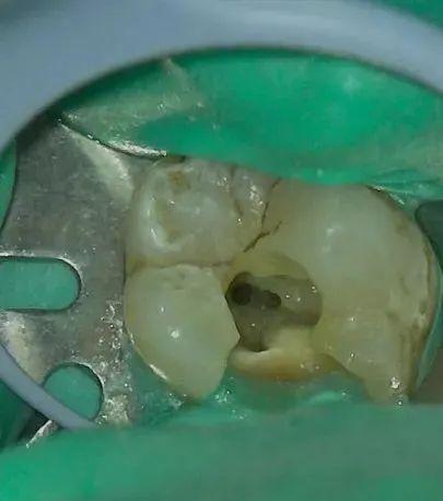 烂牙发黑根管治疗全过程,让牙齿重生的妙方