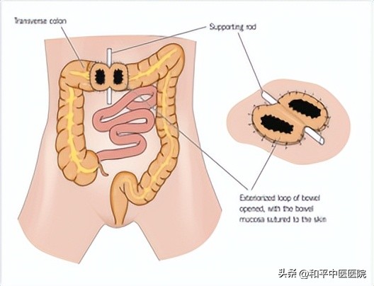 直肠癌术后多久可以装造口,三期直肠癌造口术后生存期