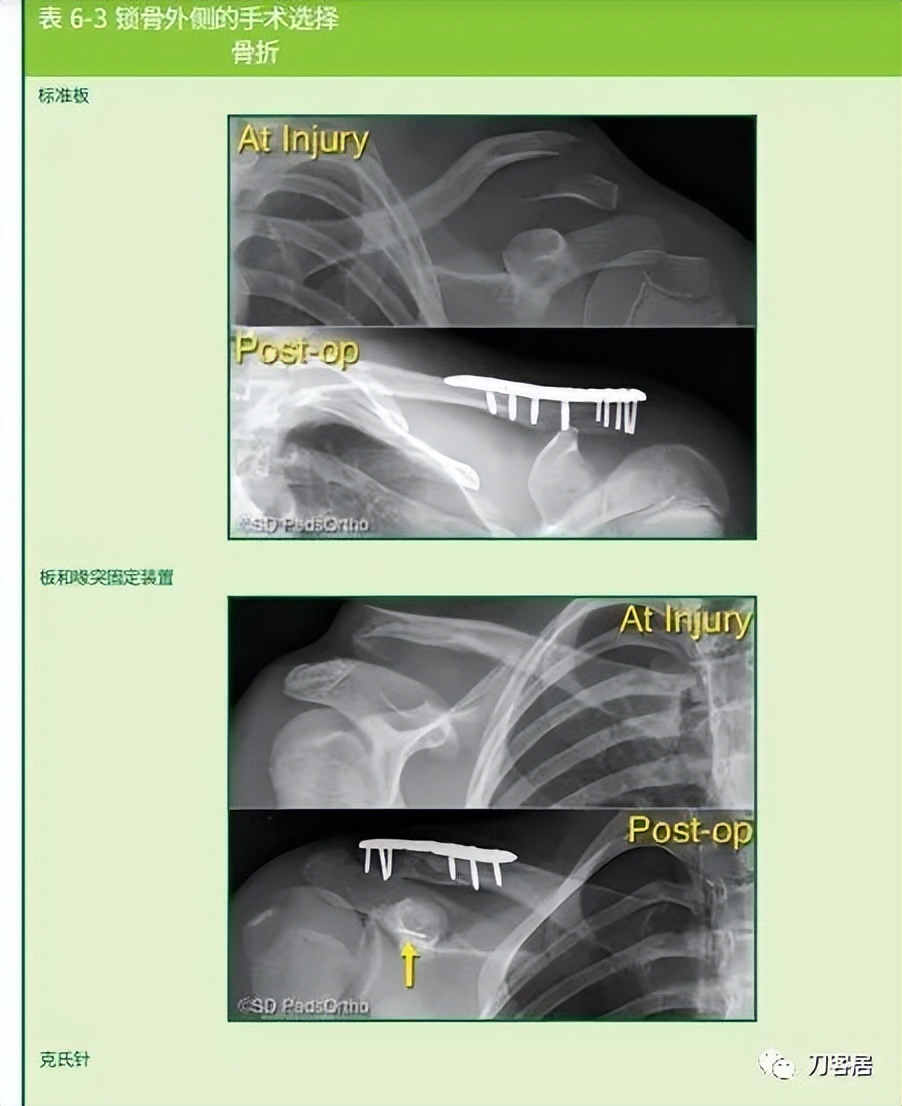 儿童锁骨骨折保守治疗的弊端,锁骨粉碎骨折错位不处理会愈合吗