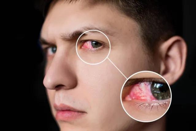 夏季过敏性结膜炎怎么治能除根,眼科医生陶勇过敏性结膜炎