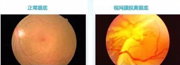 低压高为什么更可怕,低压偏高是什么原理