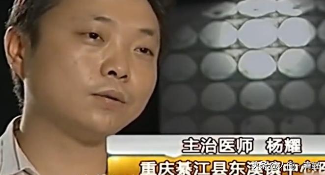 重庆一男子意外怀孕医生剖腹产,男子肚子疼去医院检查却生了个娃