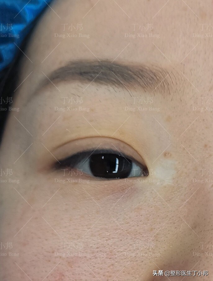 开眼角又长回去怎么办,开眼角可以留一点内眦赘皮吗