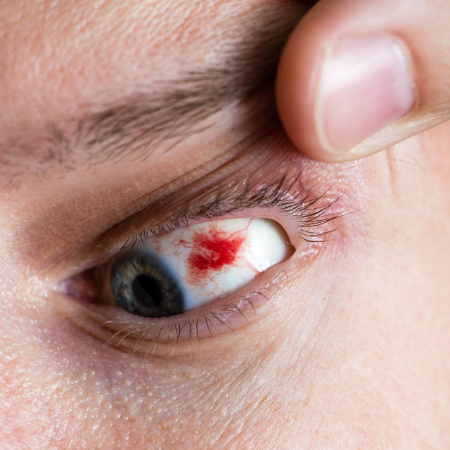 爱护眼睛，老年人如何预防眼底出血呢？医生给出答案