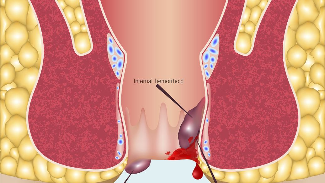 结肠息肉切除止血有哪些方法,直肠息肉切除术止血方法