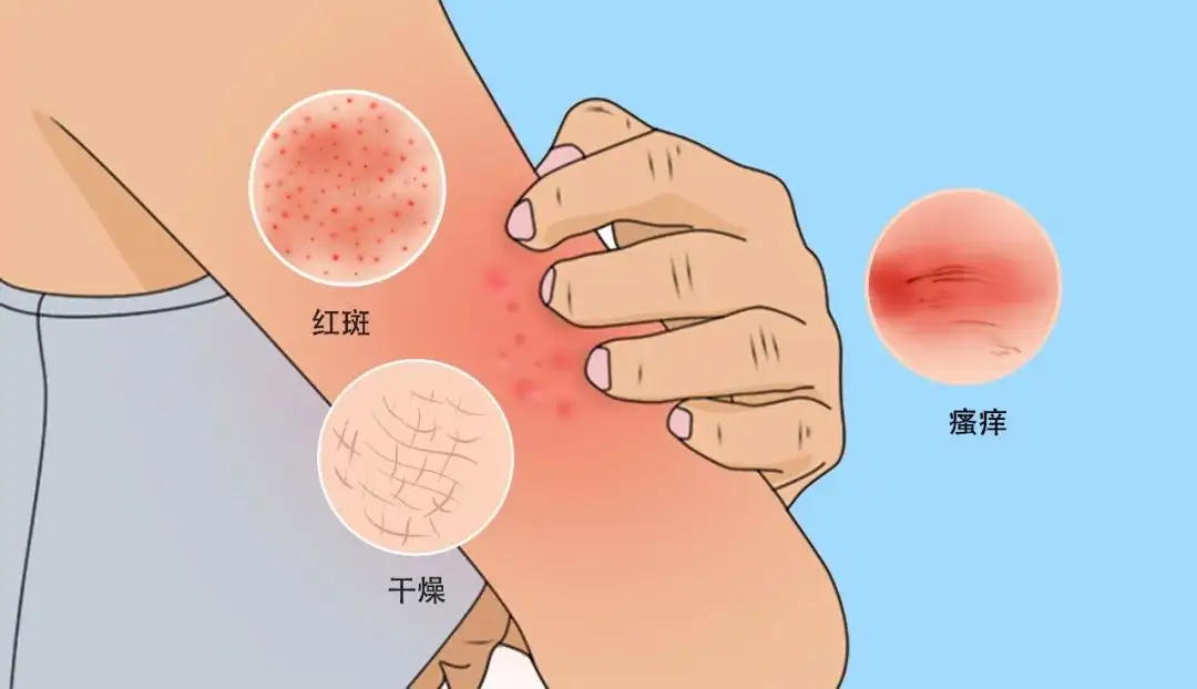 特应性皮炎中医疗法,特应性皮炎忌口食物一览表