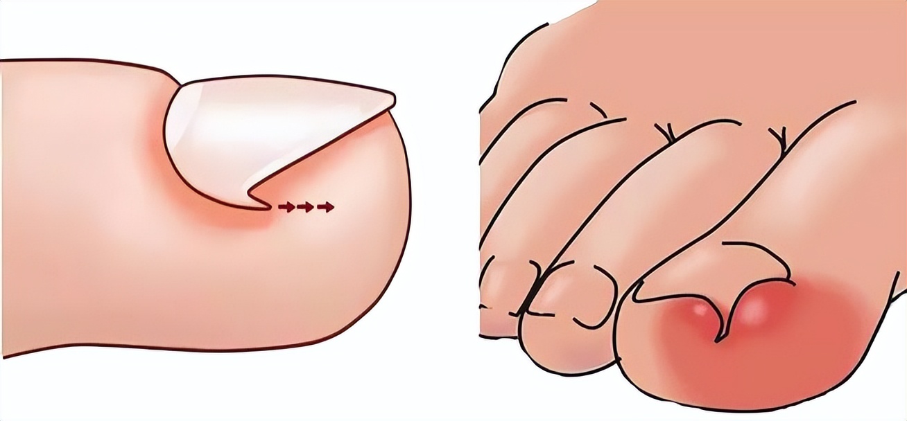 一走路脚趾甲痛,甲沟炎拔完脚趾甲很疼怎么办