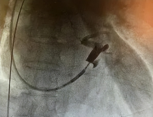 心衰患者icd植入后会加重心衰吗,43岁心衰患者植入人工心脏